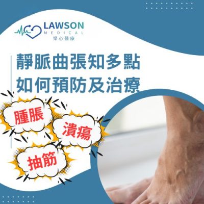 靜脈曲張